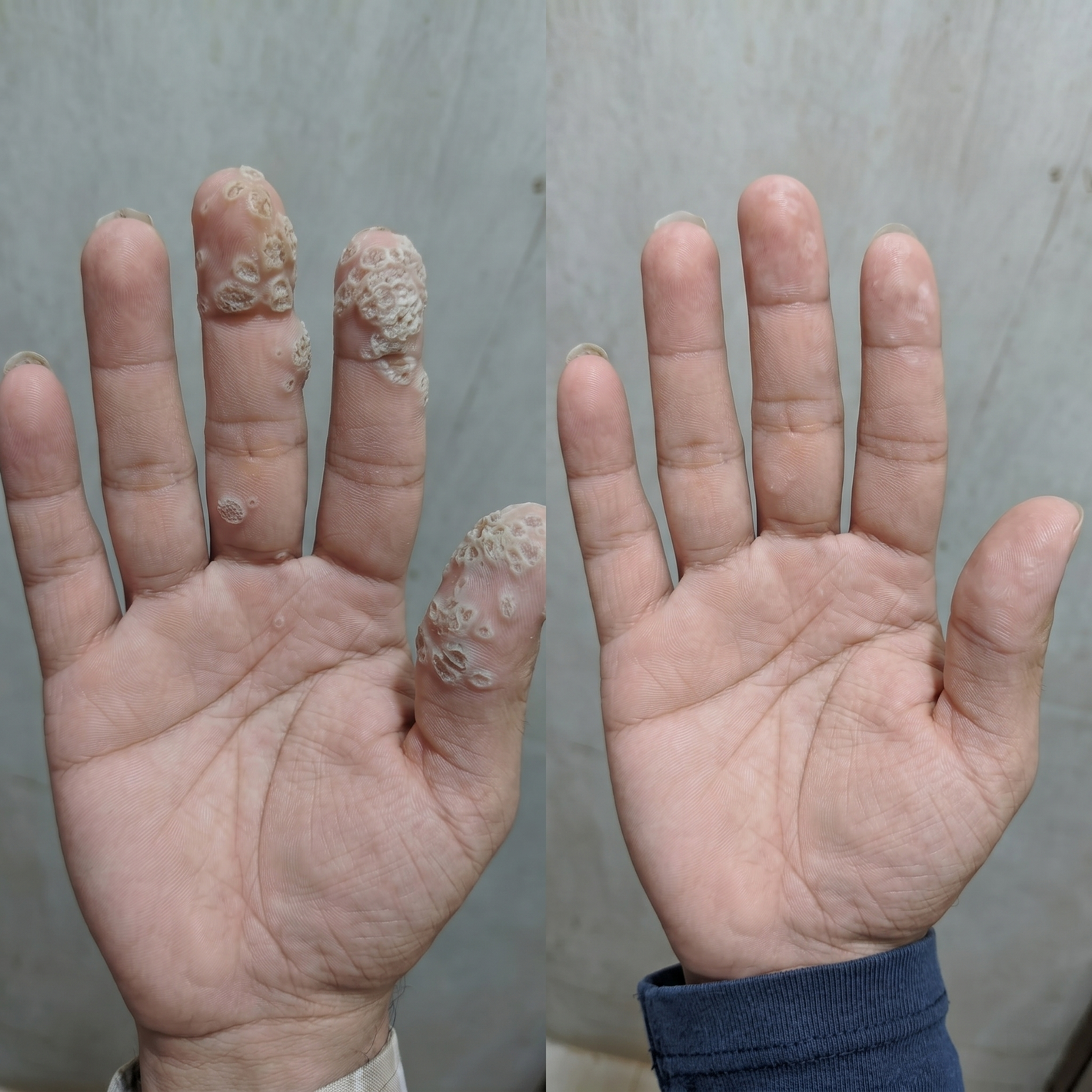 David hand warts before and after