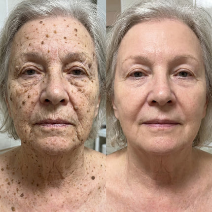 Mature facial skin before and after