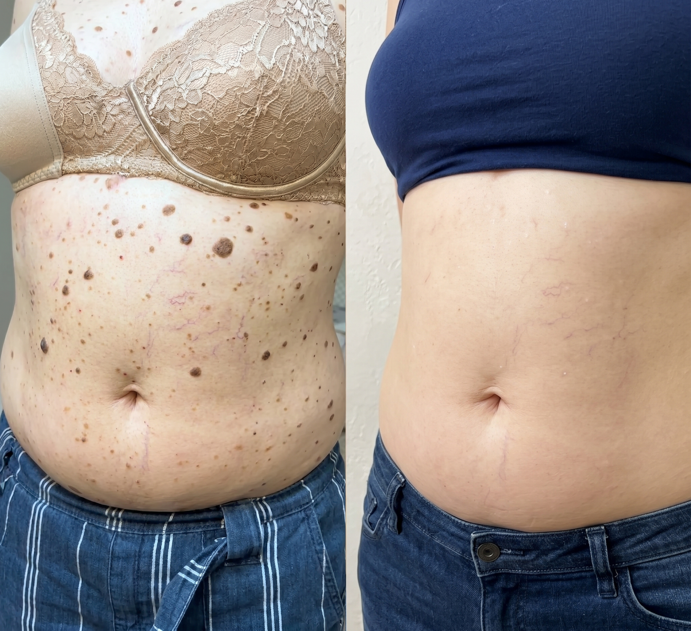 Susan body spots before and after