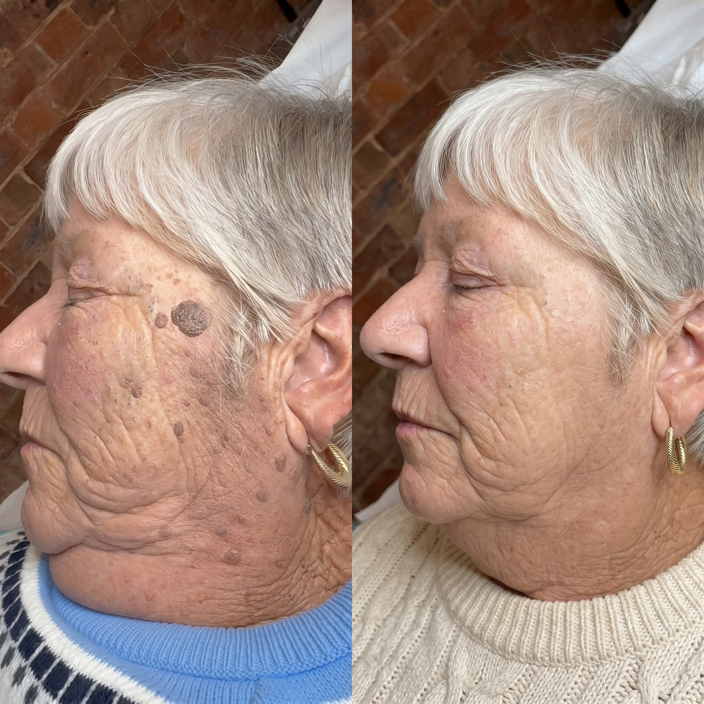 Patricia facial spots before and after